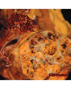 BLASTED PANCREAS - CARCINOMA